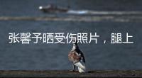 張馨予曬受傷照片，腿上淤青、額頭扎針，穿“迷彩”T恤出鏡引熱議