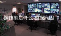 銅錢癬是什么 根據病因快速根除