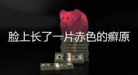 臉上長了一片赤色的癬原因是什么