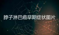 脖子淋巴癌早期癥狀圖片（了解淋巴癌的預防和治療）
