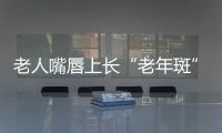 老人嘴唇上長“老年斑” 上醫院一查竟是基底細胞癌
