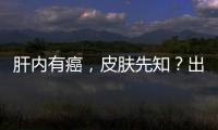 肝內有癌，皮膚先知？出現“1黑1黃2紅1癢”，勸你別不當回事