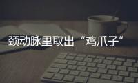 頸動脈里取出“雞爪子”