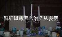 鮮紅斑痣怎么治？從發病機制講透治療難點！