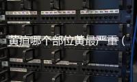 黃疸哪個部位黃最嚴重（了解黃疸的癥狀和治療方法）