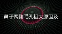 鼻子兩側毛孔粗大原因及怎么改善