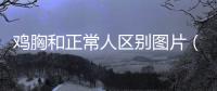 雞胸和正常人區別圖片（探討雞胸畸形的特征和治療方法）