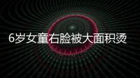 6歲女童右臉被大面積燙傷  只因使用了這個