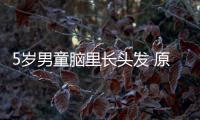5歲男童腦里長頭發 原是生出“畸胎瘤”