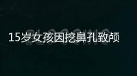 15歲女孩因挖鼻孔致顱內感染 醫生：建議使用生理鹽水