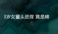 3歲女童頭皮癢 竟是蜱蟲在作祟