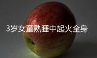 3歲女童熟睡中起火全身70%燒傷